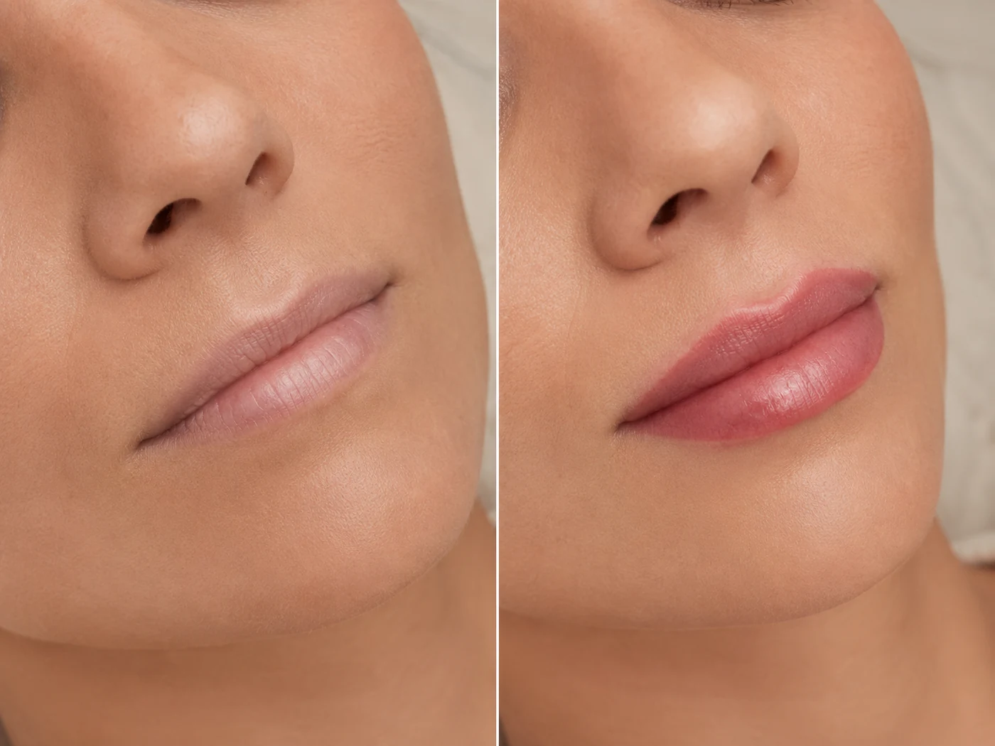 Vorher und Nachher Silk Lips